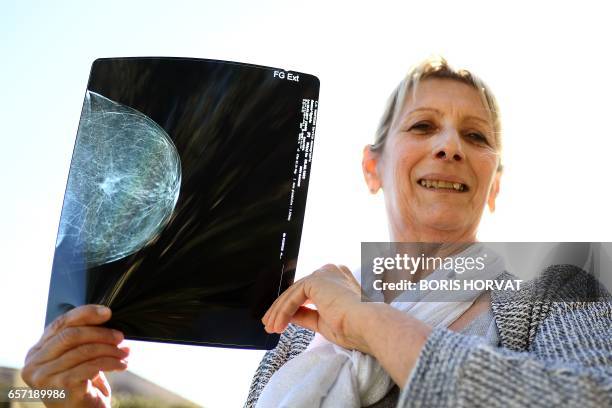 Sylvie Anane who has always lived in Fos-sur-Mer, southern France, poses at her home on March 10, 2017 with a mammogram showing a tumor. Sylvie Anane...