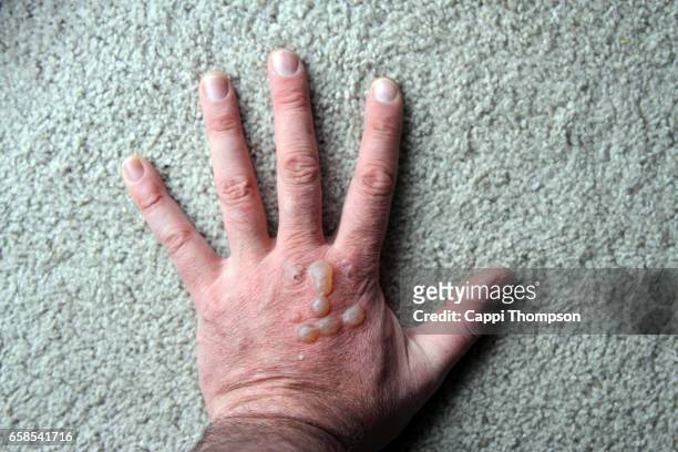 self injury burning hand - blister stock pictures, royalty-free photos & images