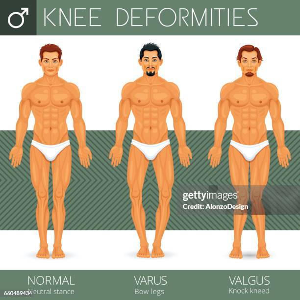 knee deformity - taking a bow stock illustrations