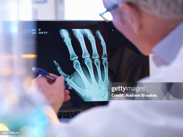 First Radiographers Hand X Ray Of Hand Photos and Premium High Res Pictures - Getty Images