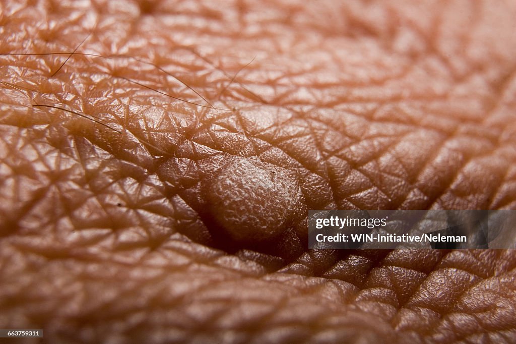 Close-up of a wart on a persons skin