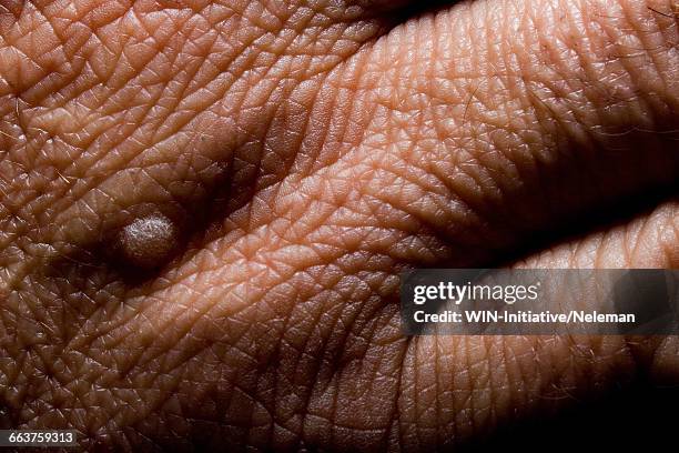 close-up of a wart on a persons hand - warts stock pictures, royalty-free photos & images