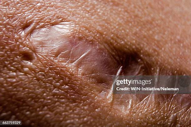 close-up of a scar on a persons skin - unvollkommenheit stock-fotos und bilder