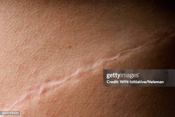 close-up of a scar on a persons skin - cicatriz fotografías e imágenes de stock