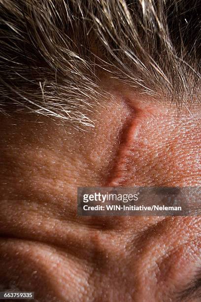 close-up of a scar on a persons forehead - cicatriz imagens e fotografias de stock