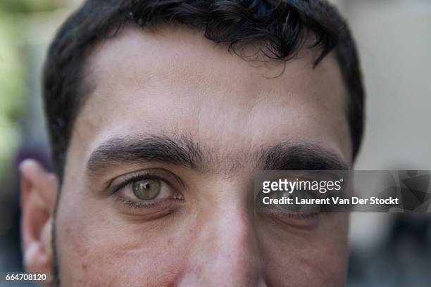 Syrian medical worker has irritated eyes after treating rebel fighters from Liwa Maghawer al Ghuta, the day after a suspected chemical weapon attack...