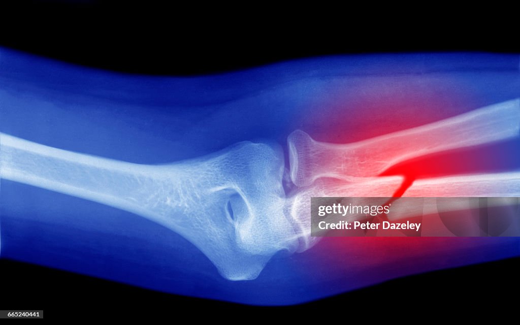 Xray of broken arm