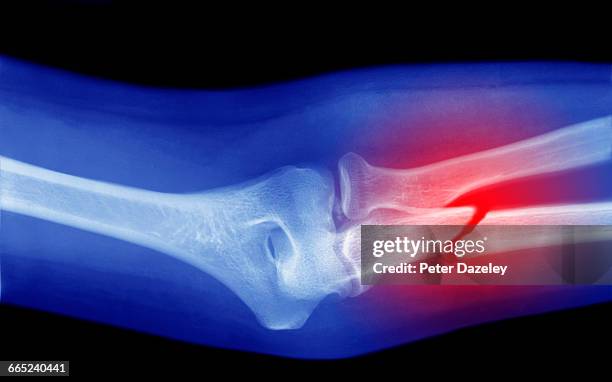 xray of broken arm - os humain photos et images de collection