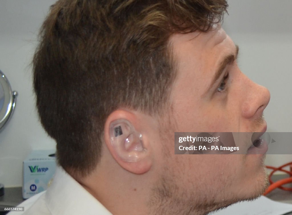 Cauliflower ear prevention