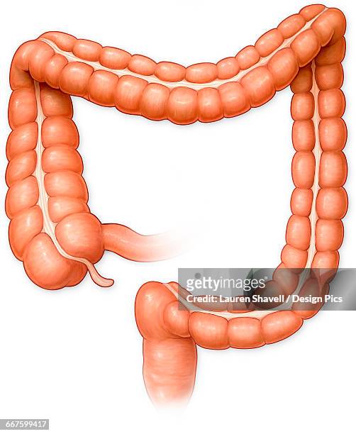 anterior view of large intestine with diverticulitis - diverticulitis stock-grafiken, -clipart, -cartoons und -symbole