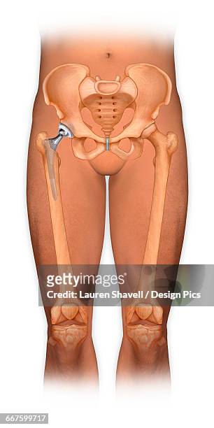 ilustrações, clipart, desenhos animados e ícones de front view of a body showing a total hip replacement - bacia artificial