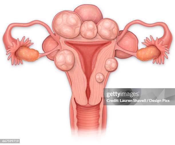bildbanksillustrationer, clip art samt tecknat material och ikoner med female anterior cross sectional view of a uterus with fibroids, vagina, cervix, fallopian tubes and ovaries - äggledare