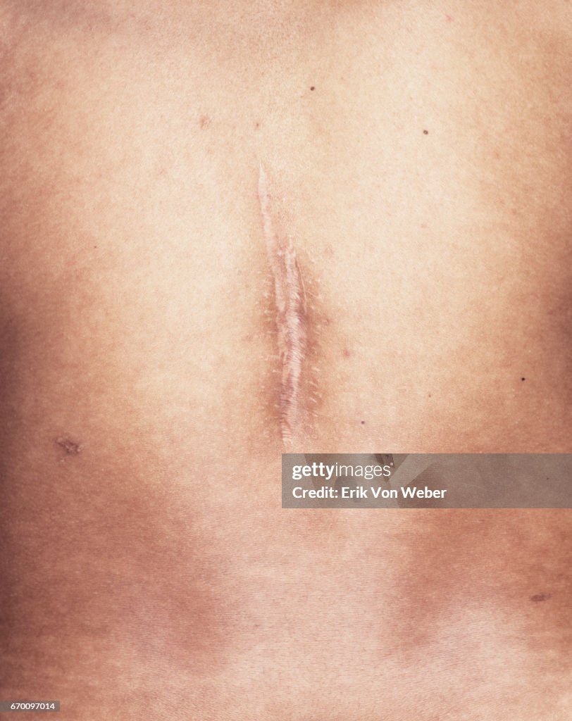 Detail of US veteran's Iraq war scar