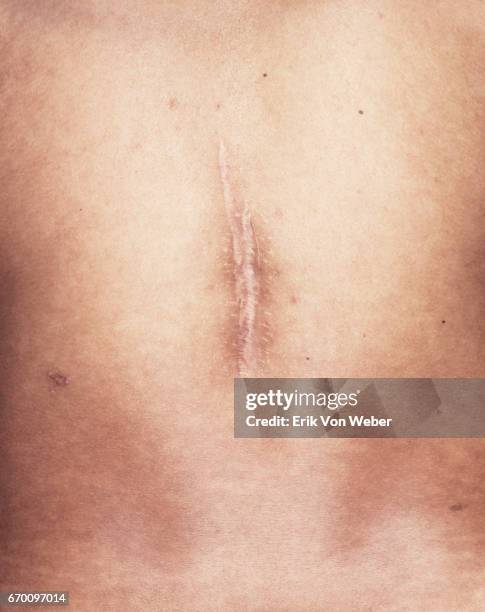 detail of us veteran's iraq war scar - guy with scar stock pictures, royalty-free photos & images