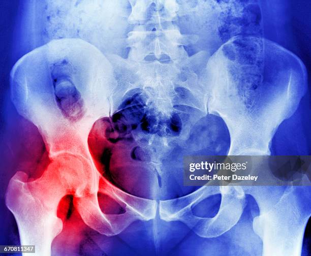 x-ray showing osteoporosis hip replacement - osteoporosis fotografías e imágenes de stock