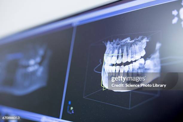 Digital Radiography Teeth 2,625 Digital Radiography Dental Stock Photos, High-Res Pictures, and ...