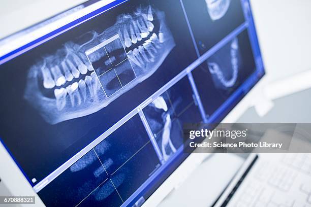 Digital Radiography Teeth Digital Radiography Dental Photos and Premium High Res Pictures - Getty ...