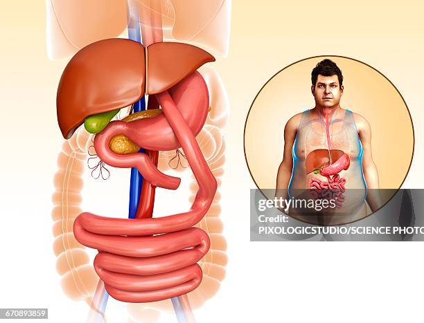 gastric bypass, illustration - bariatrics stock illustrations