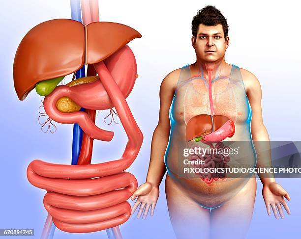 gastric bypass, illustration - bariatrics stock illustrations