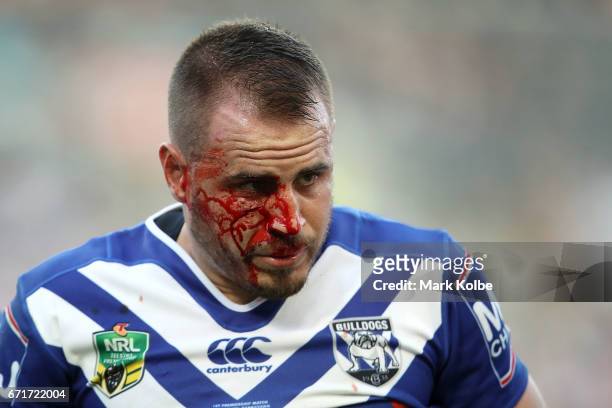 Josh Reynolds of the Bulldogs bleeds from a cut on his cheek during the round eight NRL match between the Wests Tigers and the Canterbury Bulldogs at...