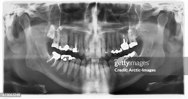 dental x-ray - vulling tandartsapparatuur stockfoto's en -beelden