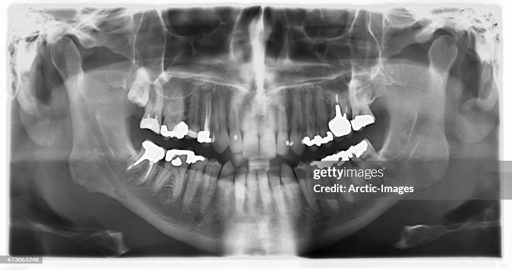 Dental X-Ray