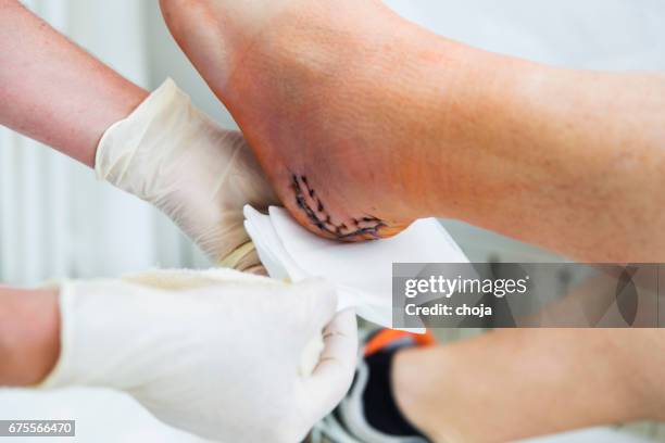 nurse is taking care of patient with achilles tendon injury - suture stock pictures, royalty-free photos & images