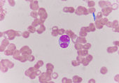 Blast cells in blood smear specimen Leukemia petient.