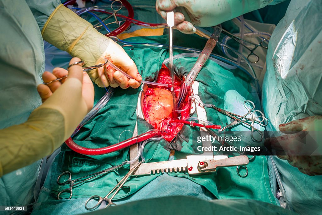 Cardiac Surgeons during a Heart Valve Operation