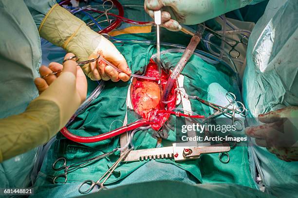 cardiac surgeons during a heart valve operation - anatomical valve stock pictures, royalty-free photos & images