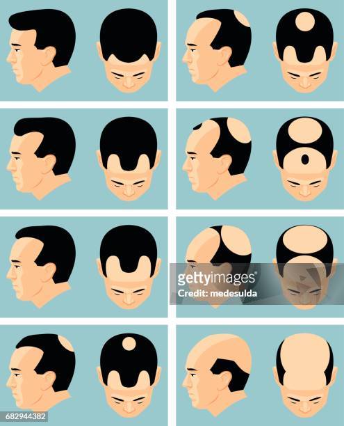 禿頭 - balding 幅插畫檔、美工圖案、卡通及圖標