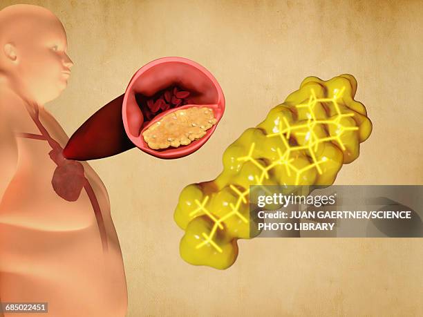 cholesterol and atherosclerosis, artwork - stenosis stock illustrations
