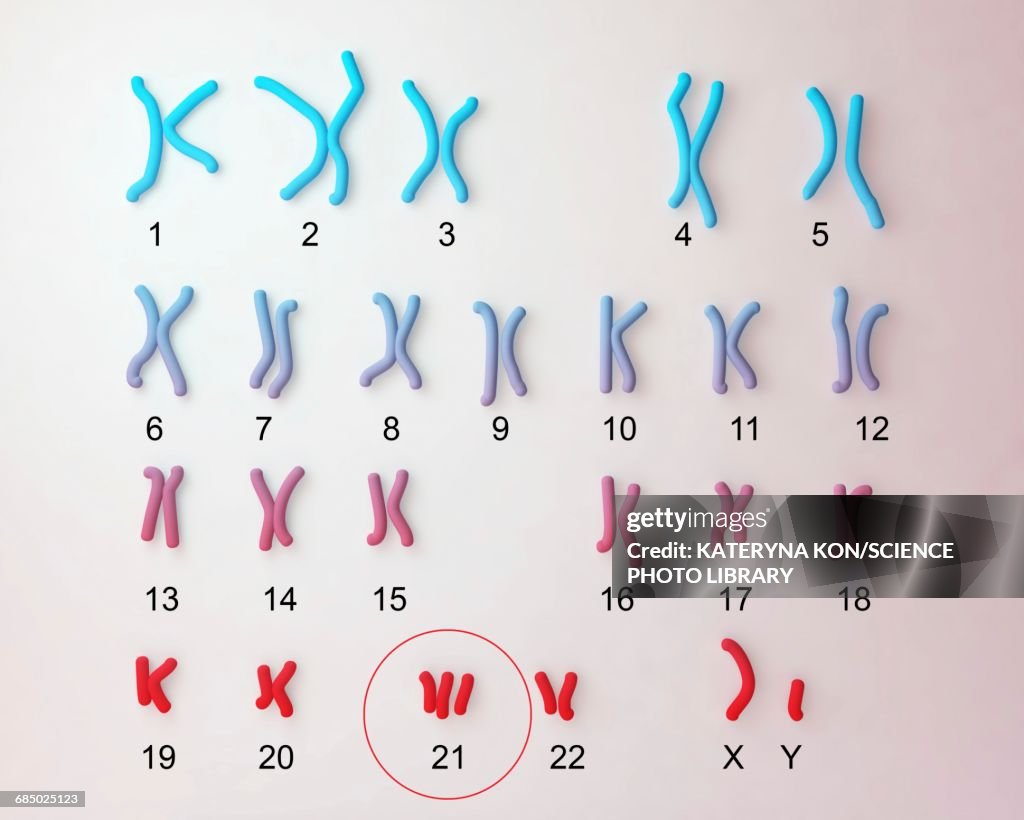 Downs syndrome karyotype, illustration