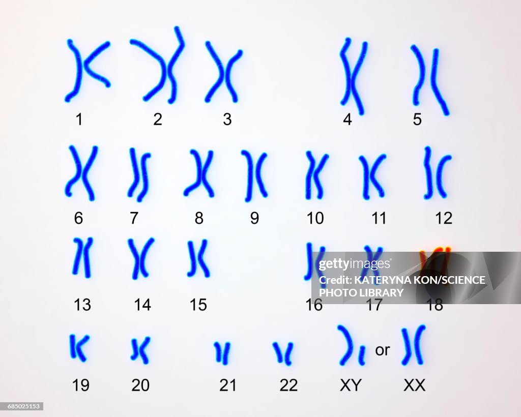 Edwards syndrome karyotype, illustration