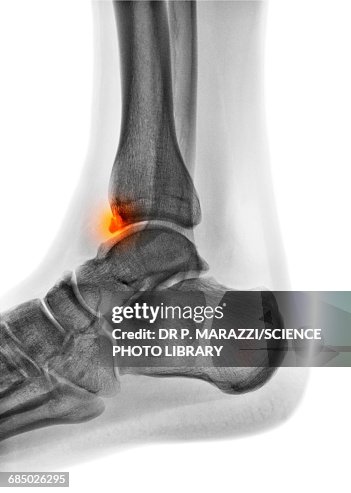 Tibial Spur Xray High-Res Stock Photo Getty Images - Main Image