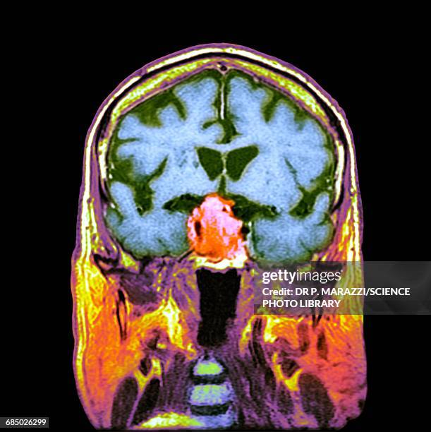 pituitary tumour, ct scan - adenoma stock pictures, royalty-free photos & images