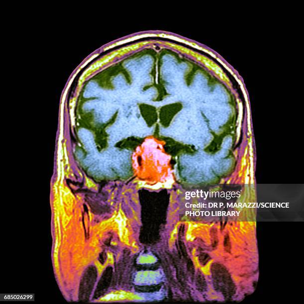 pituitary tumour, ct scan - pituitary gland stock pictures, royalty-free photos & images