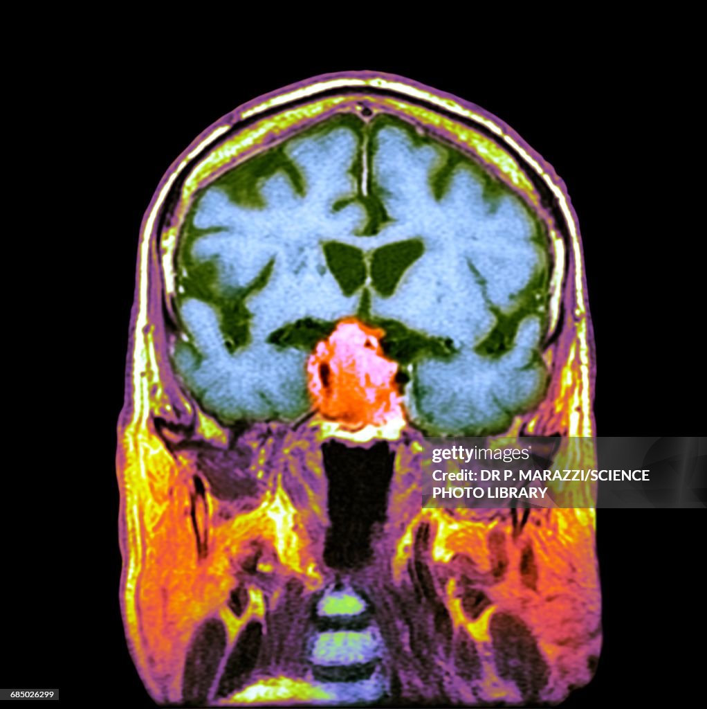 Pituitary tumour, CT scan