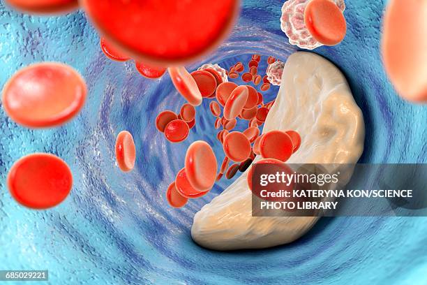 stockillustraties, clipart, cartoons en iconen met atheromatous plaque, illustration - cholesterol