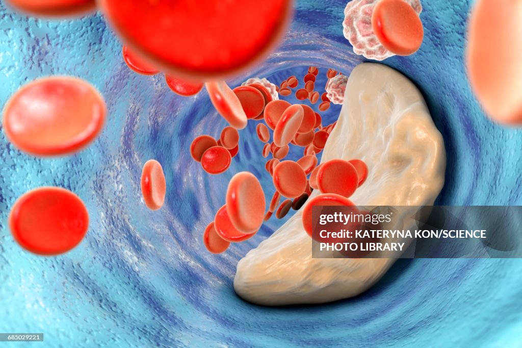 Atheromatous plaque, illustration