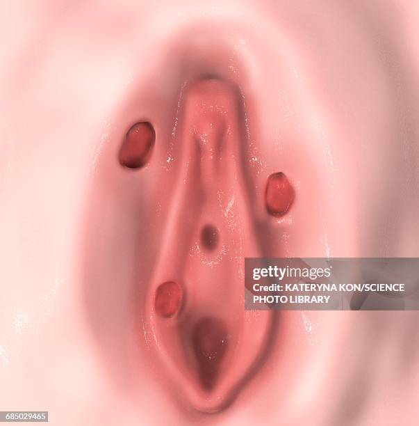 ilustrações de stock, clip art, desenhos animados e ícones de female syphilis, illustration - treponema pallidum