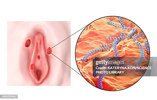 ilustrações de stock, clip art, desenhos animados e ícones de female syphilis, illustration - treponema pallidum