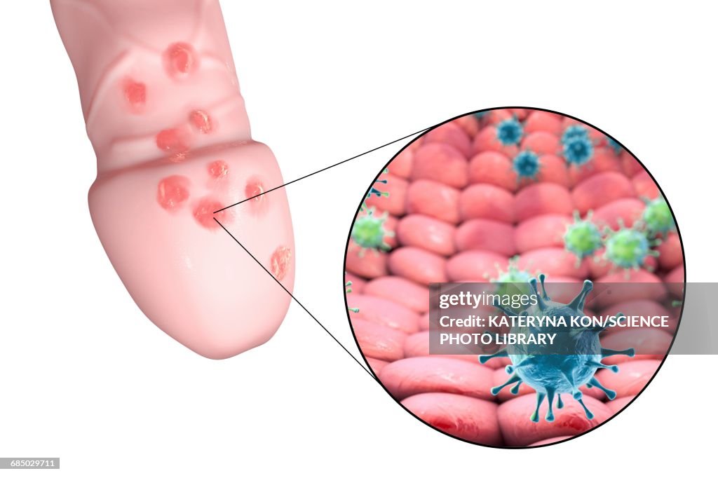 Herpes virus and lesions, illustration