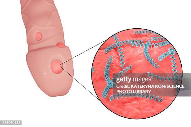 ilustrações de stock, clip art, desenhos animados e ícones de male syphilis, illustration - treponema pallidum