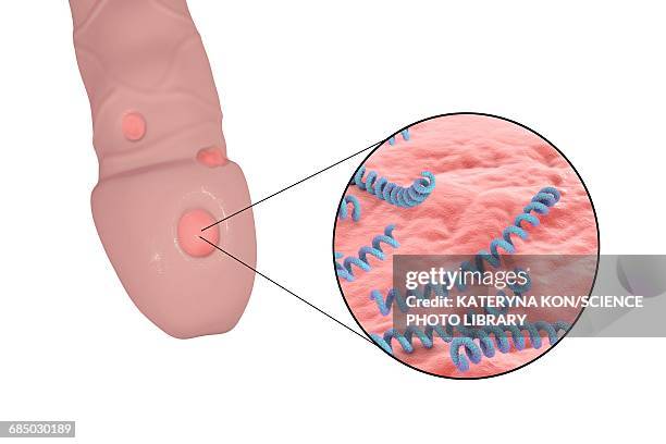 ilustrações de stock, clip art, desenhos animados e ícones de male syphilis, illustration - treponema pallidum