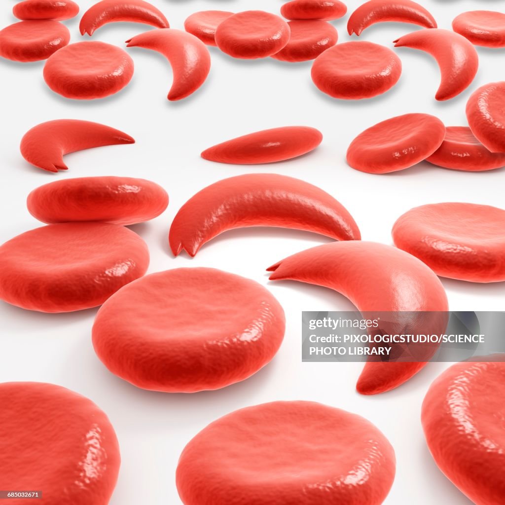 Sickle Cell Rbc Shape Red Blood Cells In Sickle Cell Anaemia High-Res Vector Graphic - Getty ...