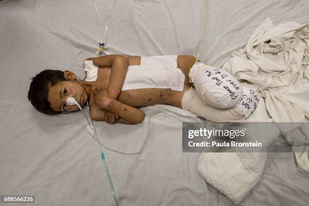 Kabir age 5, from Faryab lays in bed at the Emergency hospital in Kabul on April 3, 2016. He is a victim of a rocket attack, lost both of his legs...