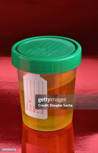 filled urine sample bottle - cholesterol test - fotografias e filmes do acervo