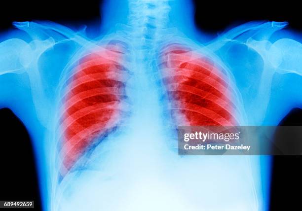 lung cancer chest x-ray - poumons photos et images de collection