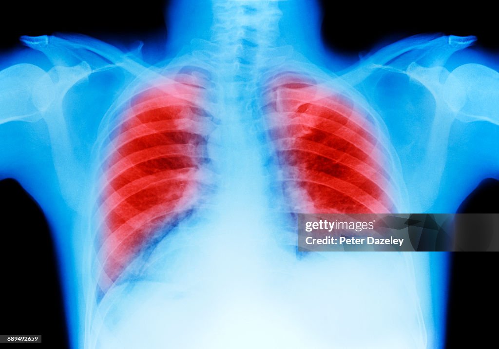 Lung cancer chest X-ray